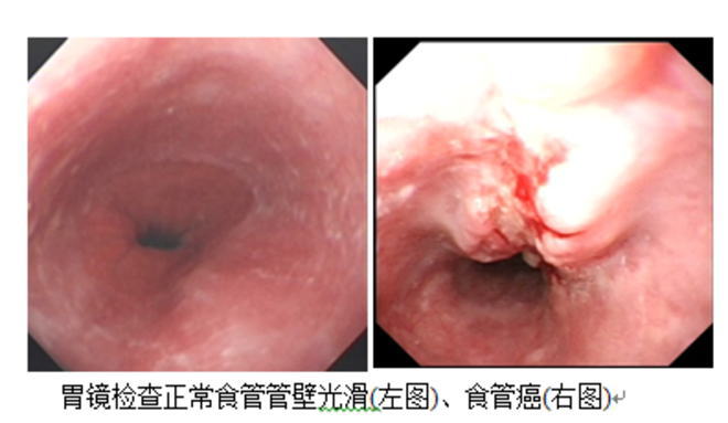 細胞免疫療法在晚期食管癌治療中的最新研究進展