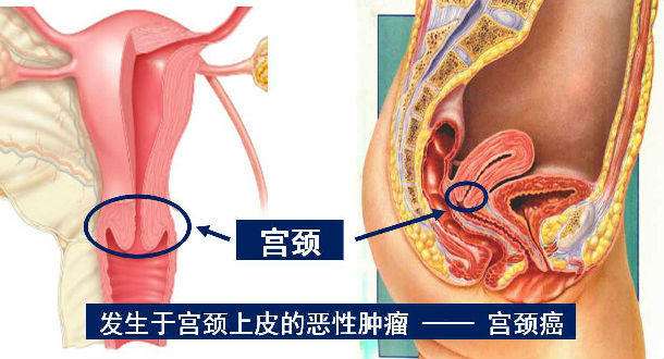 細胞免疫療法聯(lián)合放療干預晚期宮頸癌最新臨床研究