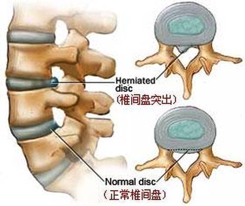 干細(xì)胞療法治療椎間盤退變最新臨床研究