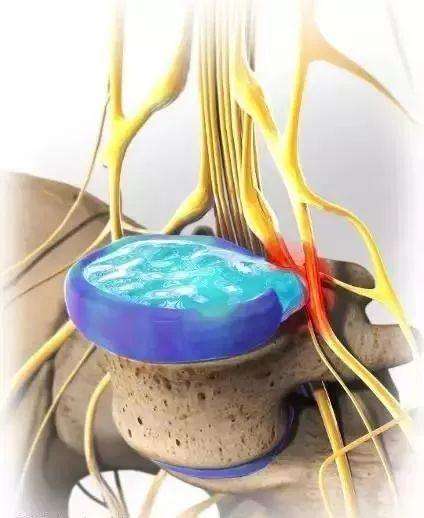 干細(xì)胞移植從這2方面修復(fù)改善椎間盤(pán)退變