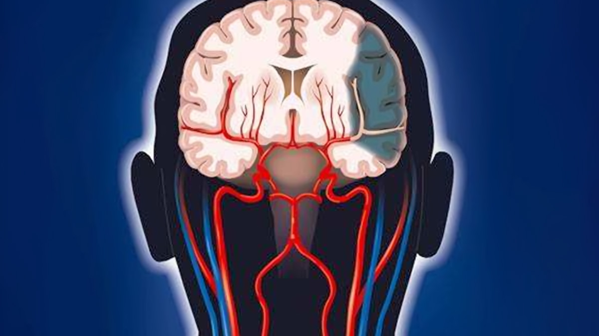 干細(xì)胞療法改善腦卒中的臨床案例：提高患者生活質(zhì)量