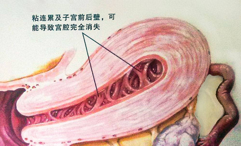 干細(xì)胞的4大作用，幫助修復(fù)宮腔粘連所致的子宮內(nèi)膜損傷