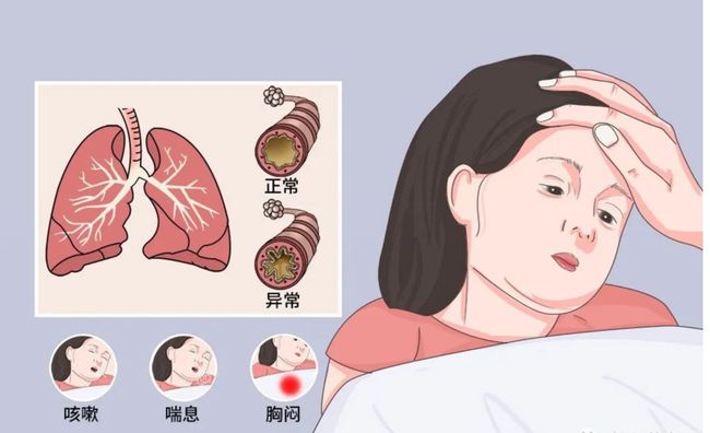 案例|自體細胞移植治療3例重癥哮喘的臨床研究