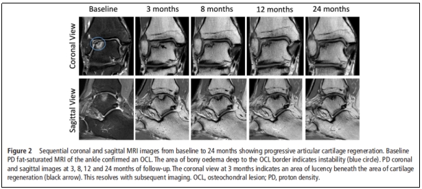 首次報道|干細(xì)胞治療踝關(guān)節(jié)軟骨損傷臨床試驗