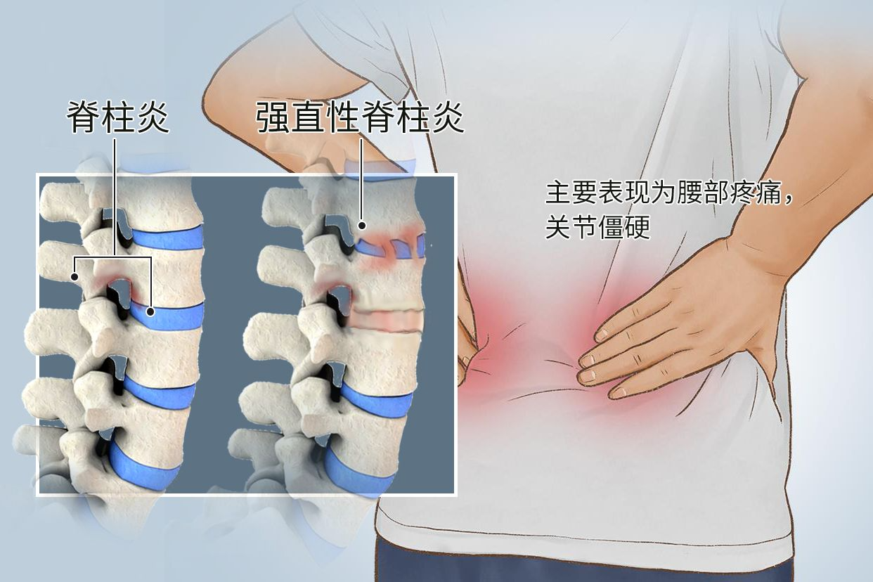 強直性脊柱炎