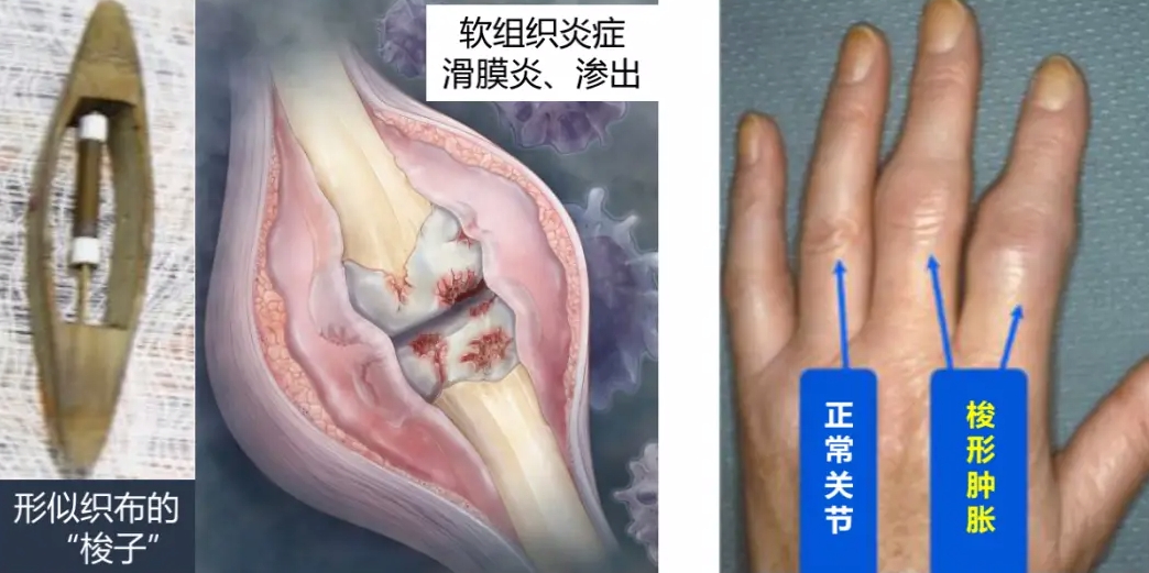 類風濕性關節(jié)炎